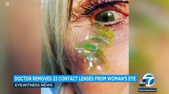 시력이 흐려지고 눈에 통증이 생겨 안과를 찾았던 여성의 한 쪽 눈에서 무려 23개의 콘텍트 렌즈가 쌓여 있었던 것으로 나타났다.