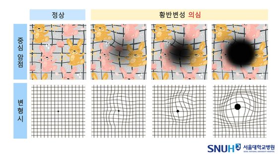 황반변성 2가지 전조증상. 사진 서울대병원