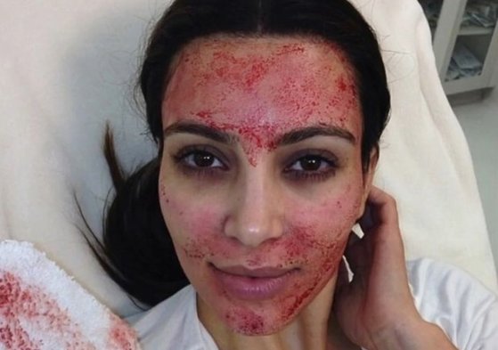 뱀파이어 시술을 받은 미국 유명 인플루언서 킴 카다시안. 사진 인스타그램 캡처
