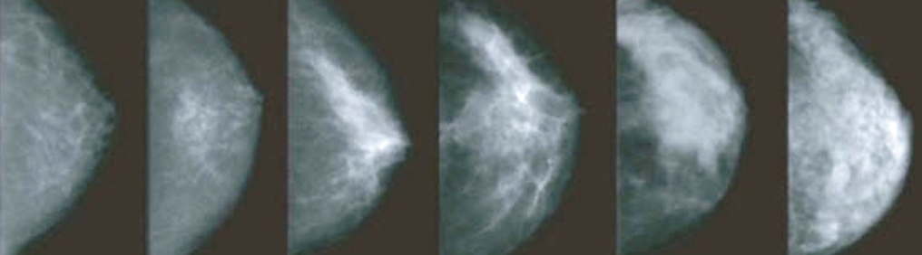 여성 유방을 옆에서 X선으로 찍은 모습. 왼쪽은 지방이 많은 유방으로 검게 보이고 오른쪽으로 갈수록 하얗게 보이는데 이는 지방 대신 유방 조직이 치밀해져 매모그램으로는 종양을 찾기 어려워진다.