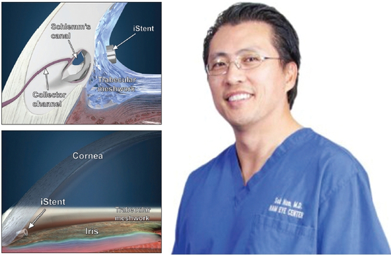 합병증이 적고 회복이 빠른 최신 녹내장 수술법을 실시하고 있는 남석환 안과 전문의.