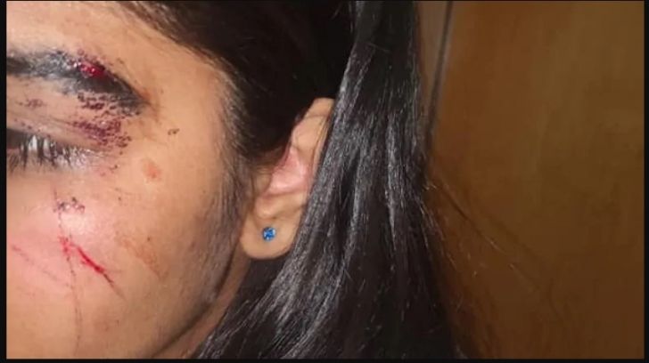 포코에서 발생한 남여 학생간 폭행사건의 피해학생이라 주장하는 여학생의 어머니가 CBC에 제공한 사진 켑쳐.

