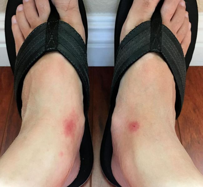부에나파크 사무실에서 근무하던 중 발목과 발등을 모기에 집중적으로 물린 한 남성의 발 사진. 가려워 긁고 나니 물린 자리가 벌겋게 부풀었다. 